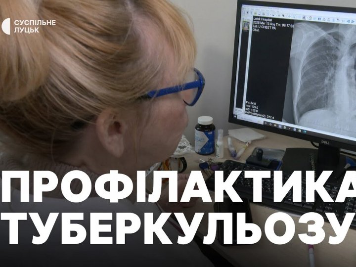 На Волині за два місяці 2025 року виявили 92 нові випадки та рецидиви туберкульозу